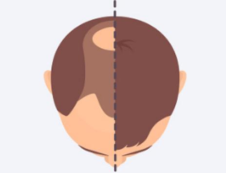 COMMENT SE PRÉSENTE L’ALOPÉCIE ANDROGÉNÉTIQUE CHEZ L’HOMME ?